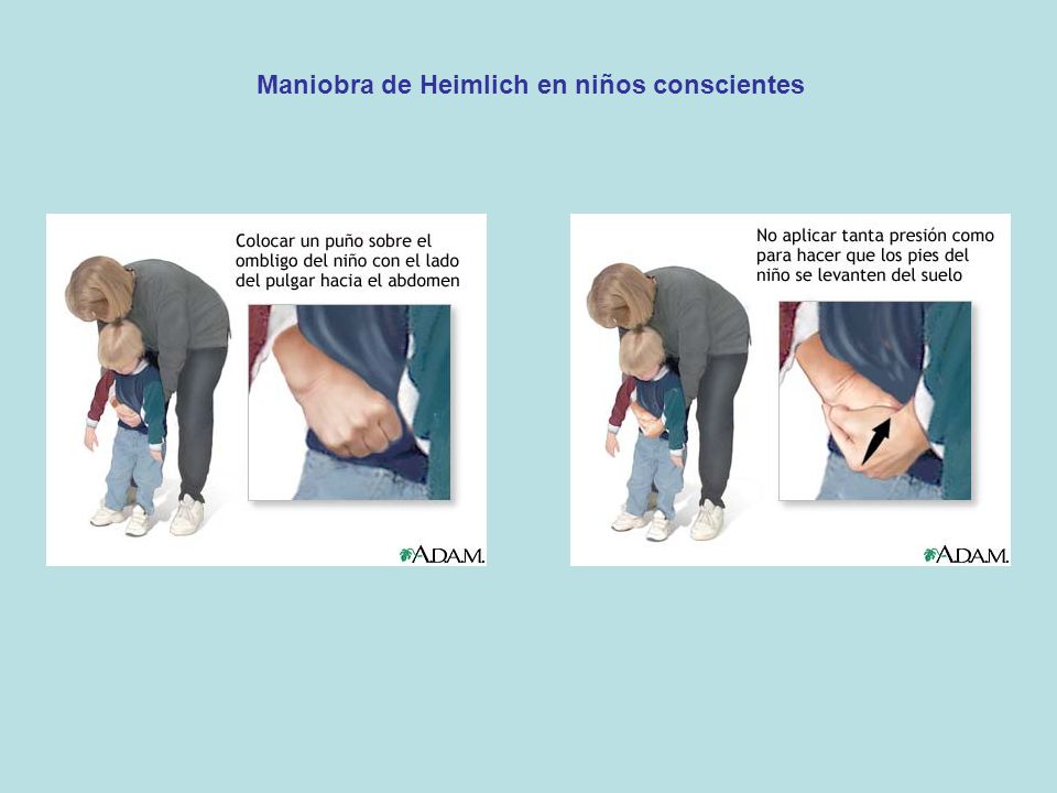 Maniobra de heimlich en ninos video
